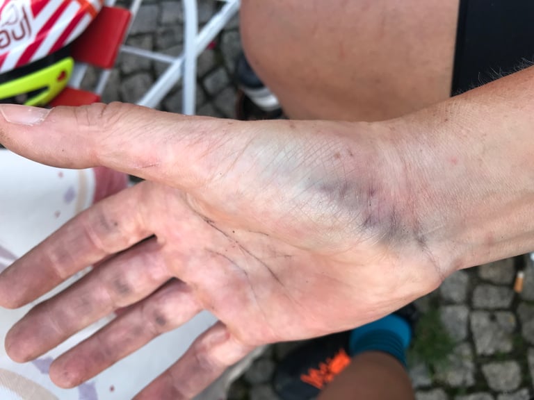 Bruised, swollen wrist and hand of a Grenzsteintrophy rider, held out palm up.